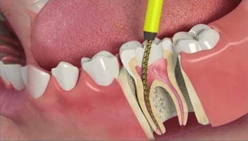 root-canal-com root canal treatment angamaly