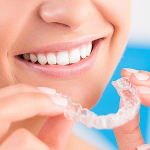 clear aligner